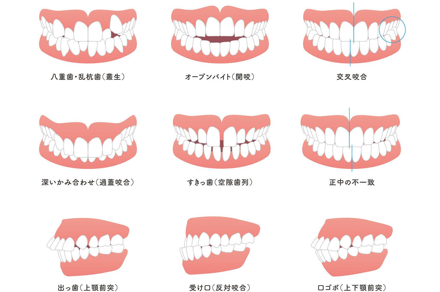 悪い歯並びを放置するデメリット